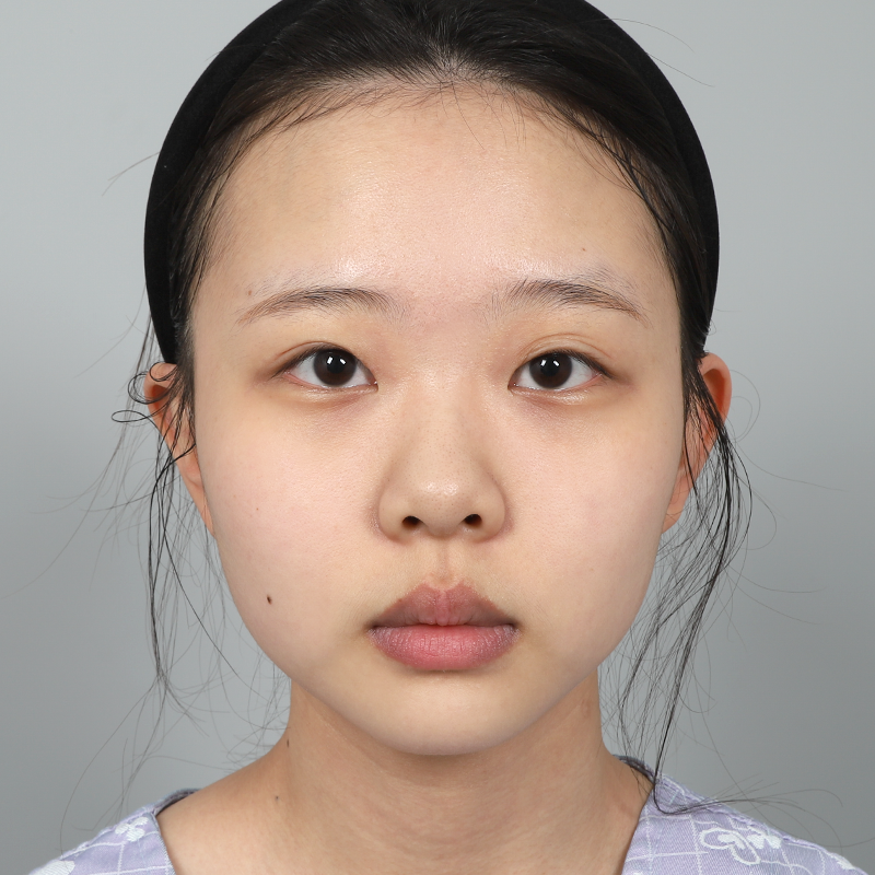 #부분절개 #윗트임 #유착풀기 #콧대(실리콘) #코끝(자가연골)눈재수술