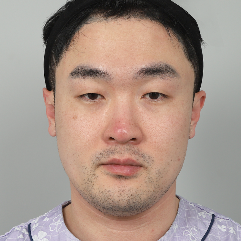 #부분절개 #눈매교정 #콧대(실리콘) #코끝(자가연골)