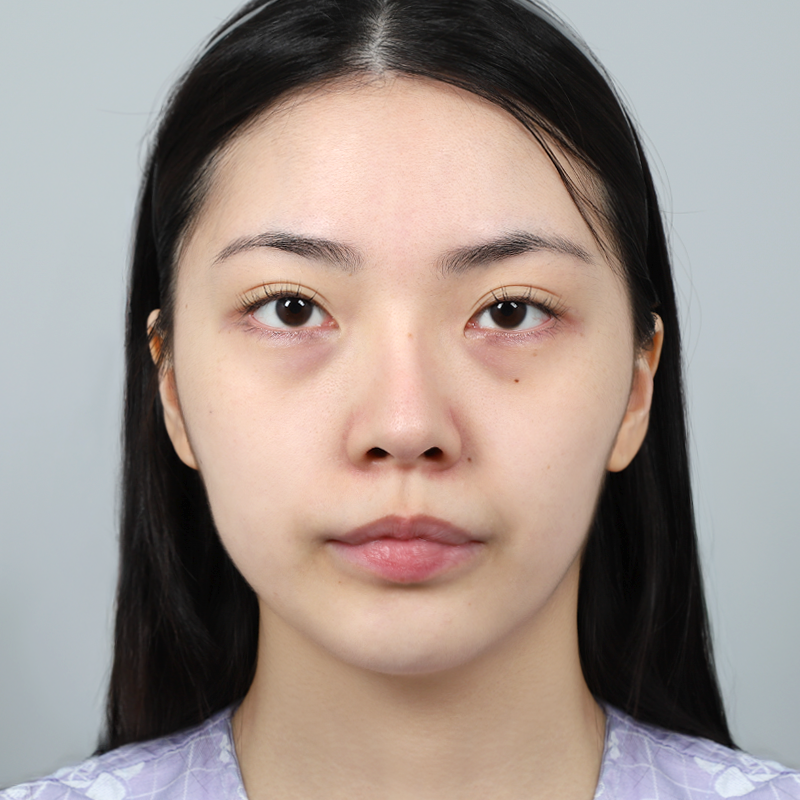 #눈밑지방재배치 #얼굴지방이식풀페이스 지방이식