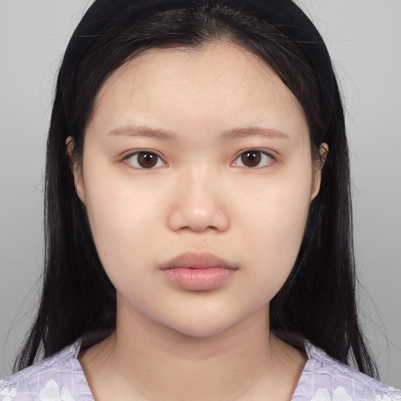 #콧대(실리콘) #코끝(자가연골) #짧은코(들창코) 교정