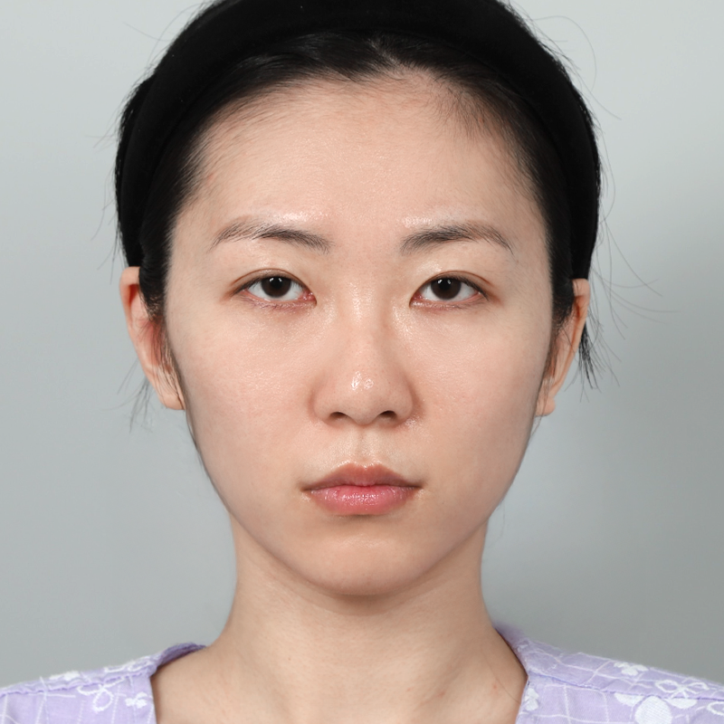 #얼굴지방이식 #콧대(실리콘) #코끝(자가연골) #자가늑 코성형풀페이스 지방이식