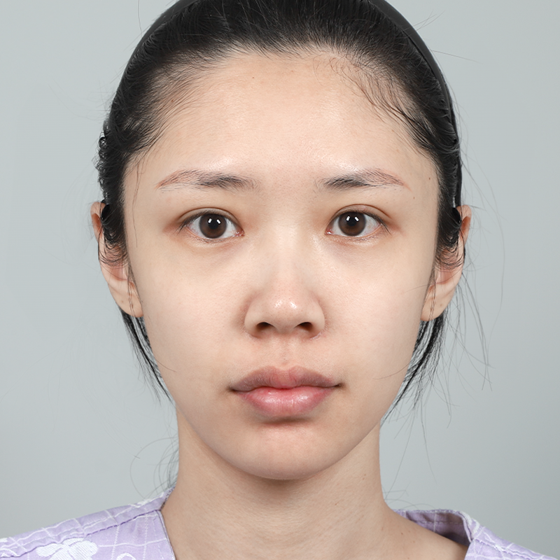 #콧대(실리콘) #코끝(자가연골)