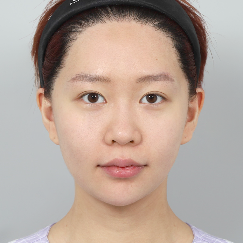 #콧대(실리콘) #코끝(자가연골) #복코교정