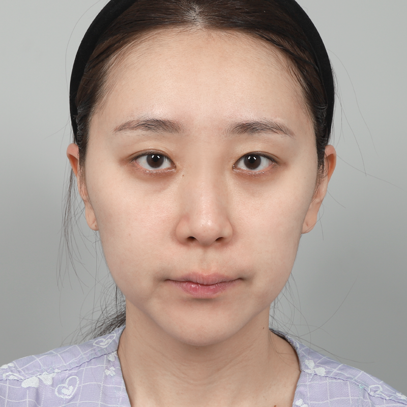 #부분절개 #눈매교정 #눈밑지방재배치 #무보형물코성형 #코끝(자가연골)