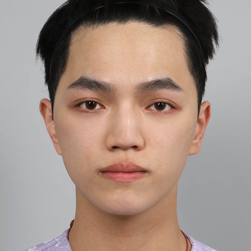 #콧대(실리콘) #코끝(자가연골) #자가늑 코성형 #매부리코 교정