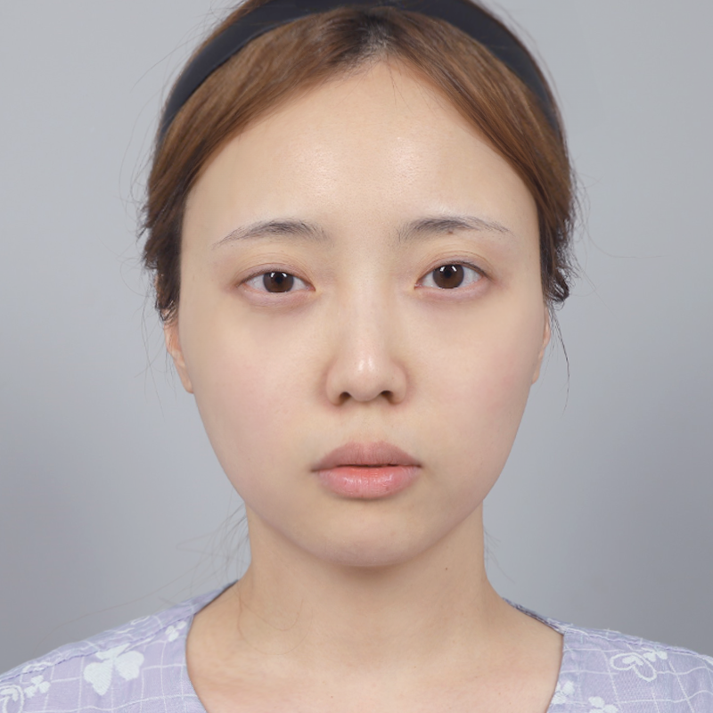 #부분절개 #윗트임 #눈위지방이식 #눈매교정