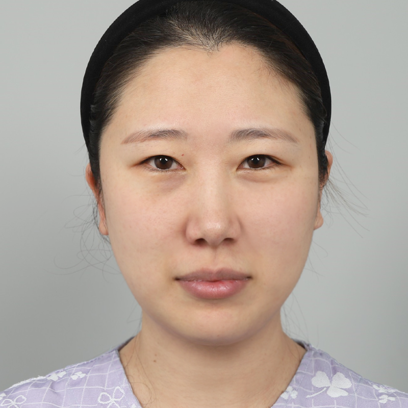 #완전절개 #뒤밑트임 #눈위지방제거 #눈밑지방재배치 #윗트임눈재수술