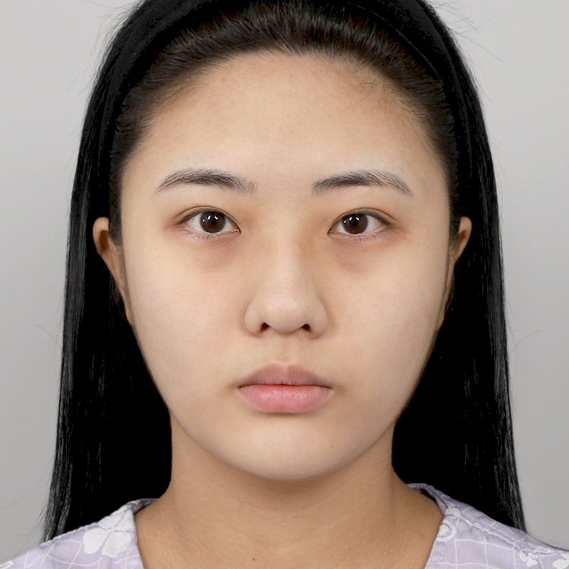 #콧대(실리콘) #코끝(자가연골) #자가늑 코성형