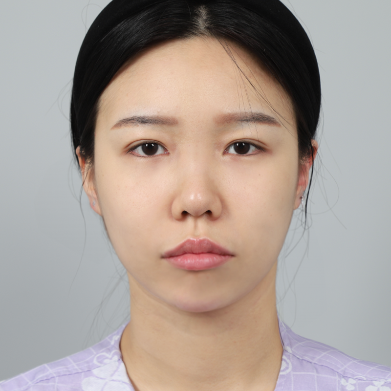 #콧대(실리콘) #코끝(자가연골) #부분절개 #윗트임 #뒤밑트임