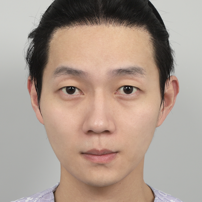 #부분절개 #눈매교정