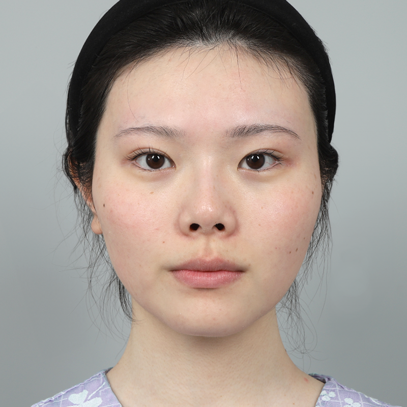 #콧대(실리콘) #코끝(자가연골) #자가늑 코성형 #짧은코(들창코) 교정