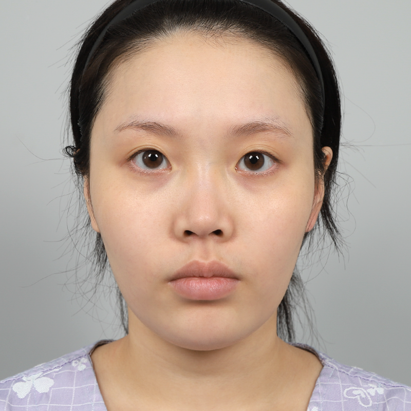 #부분절개 #콧대(실리콘) #코끝(자가연골)