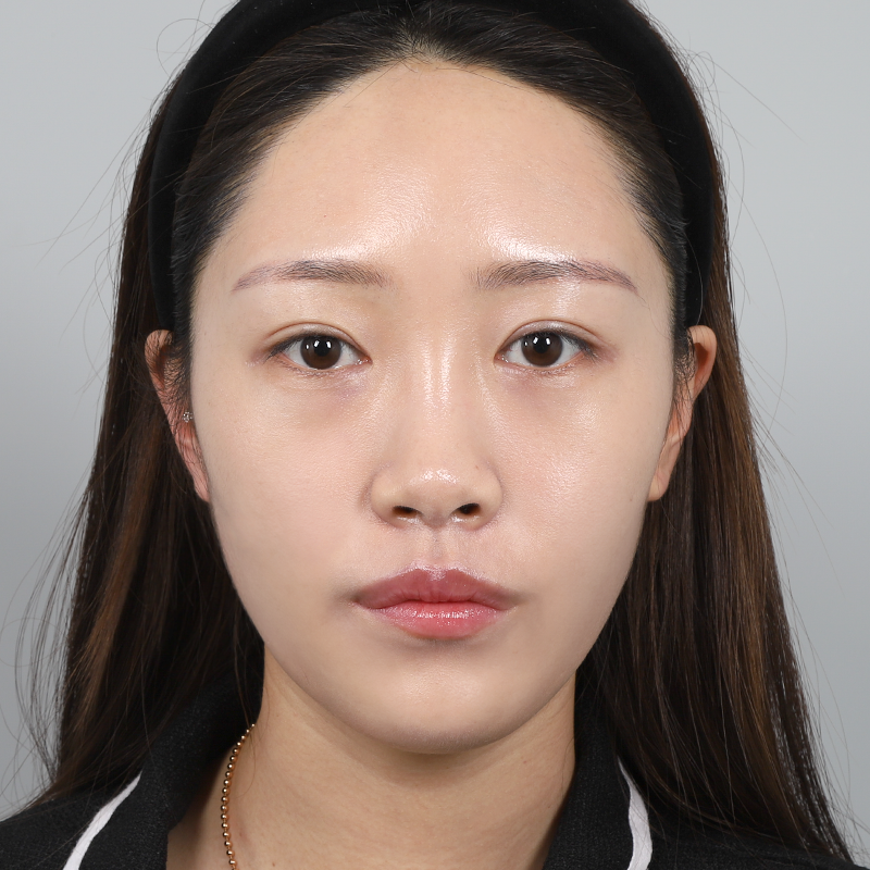 #콧대(실리콘) #코끝(자가연골) #눈밑지방재배치풀페이스 지방이식