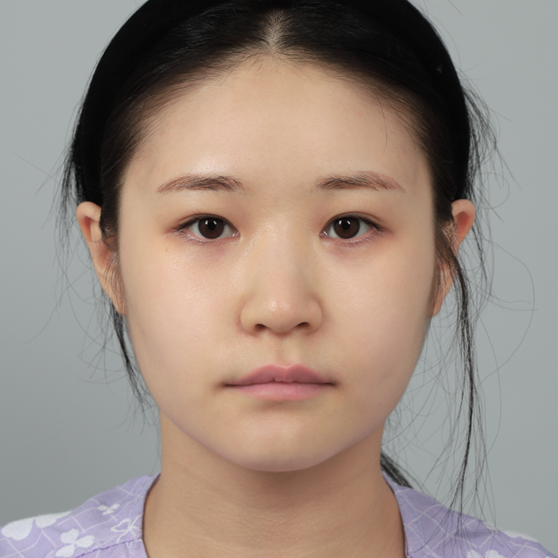 #콧대(실리콘) #코끝(자가연골)