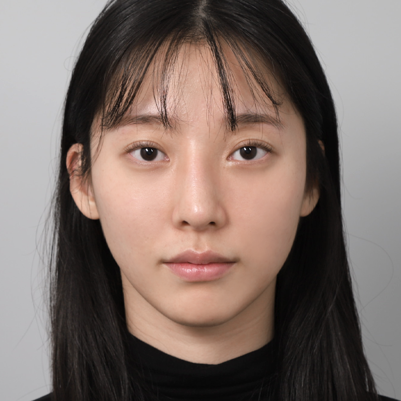 #코끝(자가연골) #무보형물코성형 #매부리코 교정 #코재수술