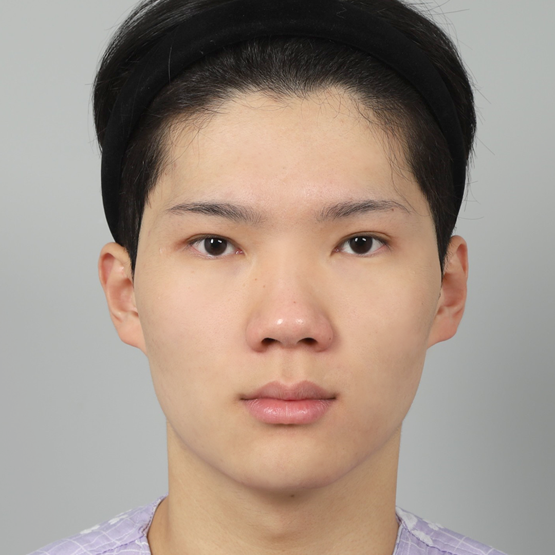 #콧대(실리콘) #코끝(자가연골)